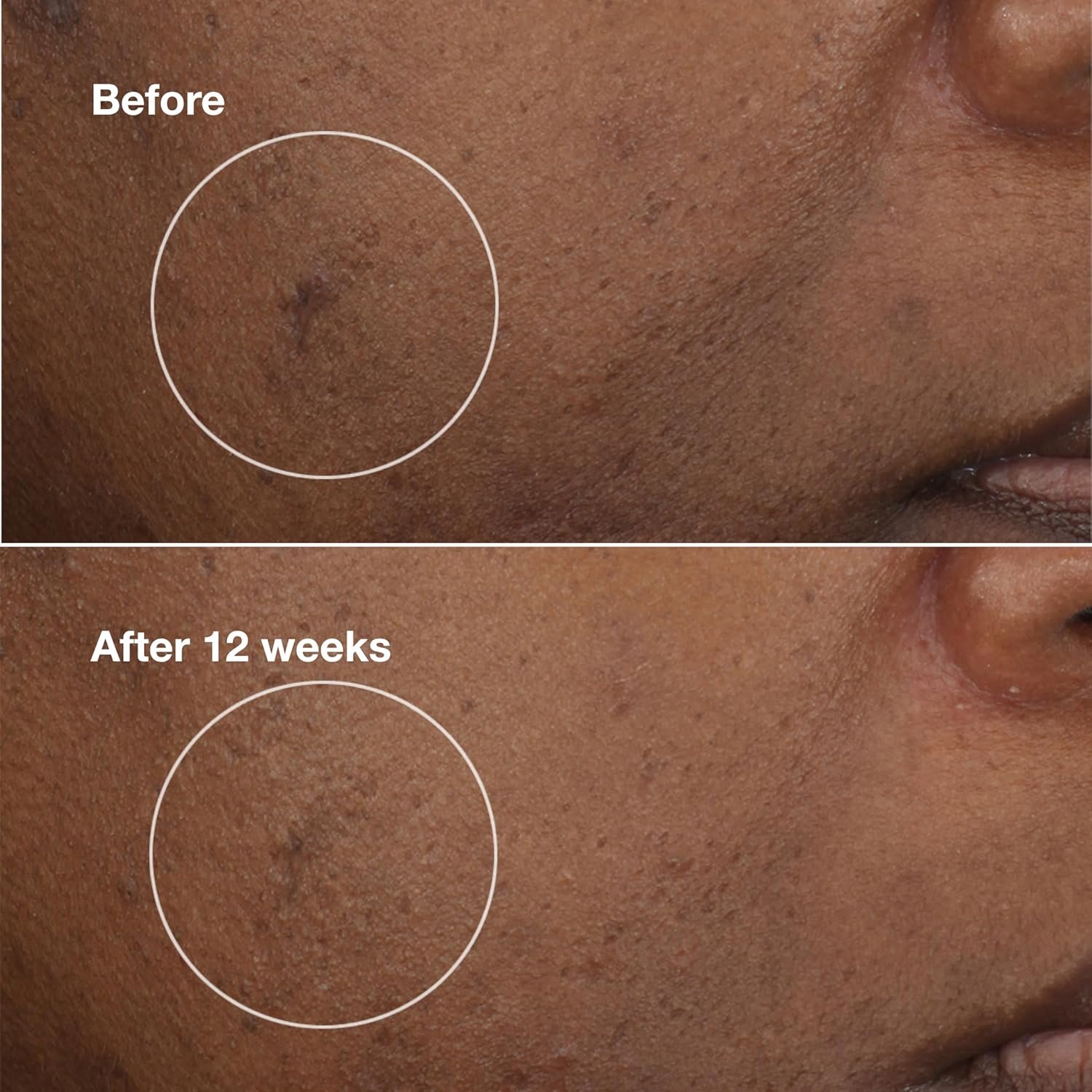 Clinique Even Better Clinical Brightening Moisturizer With Salicylic Acid, Glucosamine + Vitamin C | Hydrating + Dark Spot Reducing - Image 4