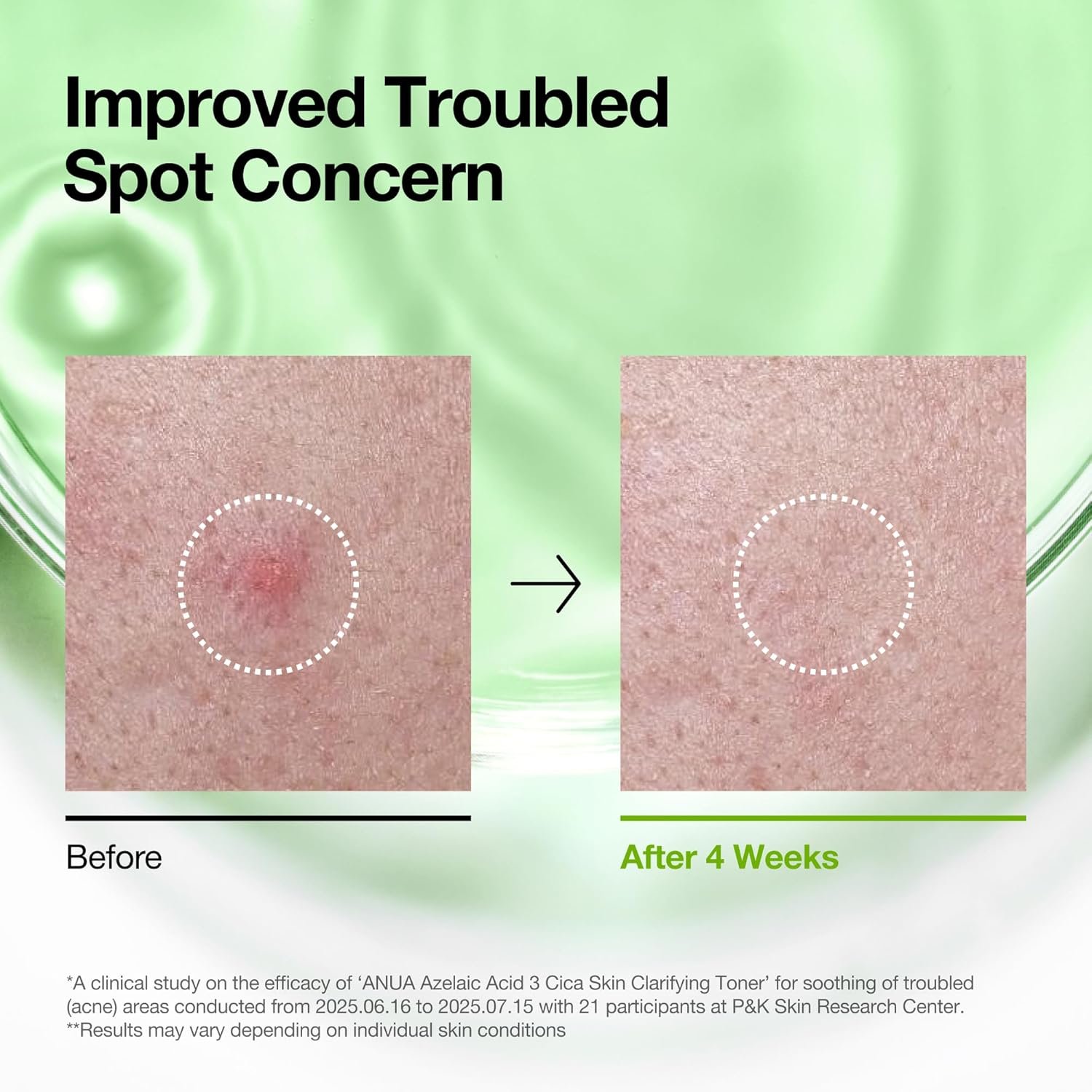 Anua Azelaic Acid 3 CICA Skin Claryfing Toner, Soothing & Clear Care, with Salicylic Acid & Azelaic Acid, Sebum & Spot Care, Suitable for Sensitive Skin, Korean Skin Care (250ml / 8.45 fl.oz.) - Image 5